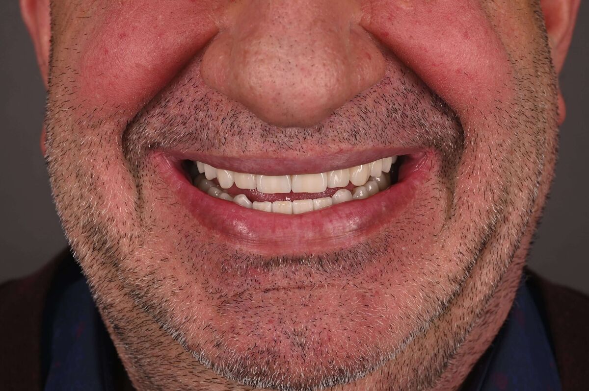 Zâmbet lateral stanga_dupa